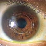 白内障で悩んでいる方へ!白内障手術体験記①発症から手術決断まで!